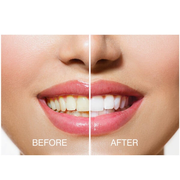 Rio Rio Smile White Advanced Teeth Whitening Kit Offerta