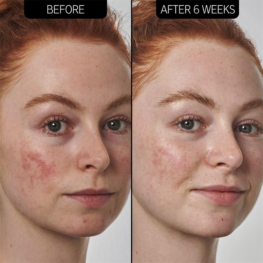 The INKEY List Sieri SuperSolutions 10% Azelaic Acid Serum Prezzo Ridotto