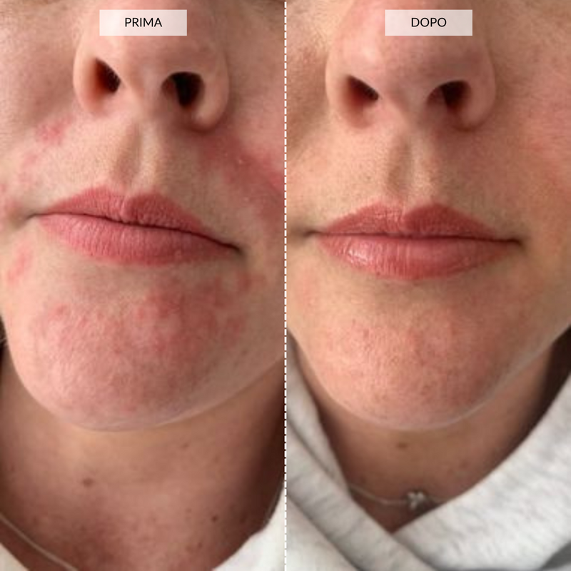 CurrentBody Skin Dispositivo di fototerapia a Luce LED Prezzo Ridotto