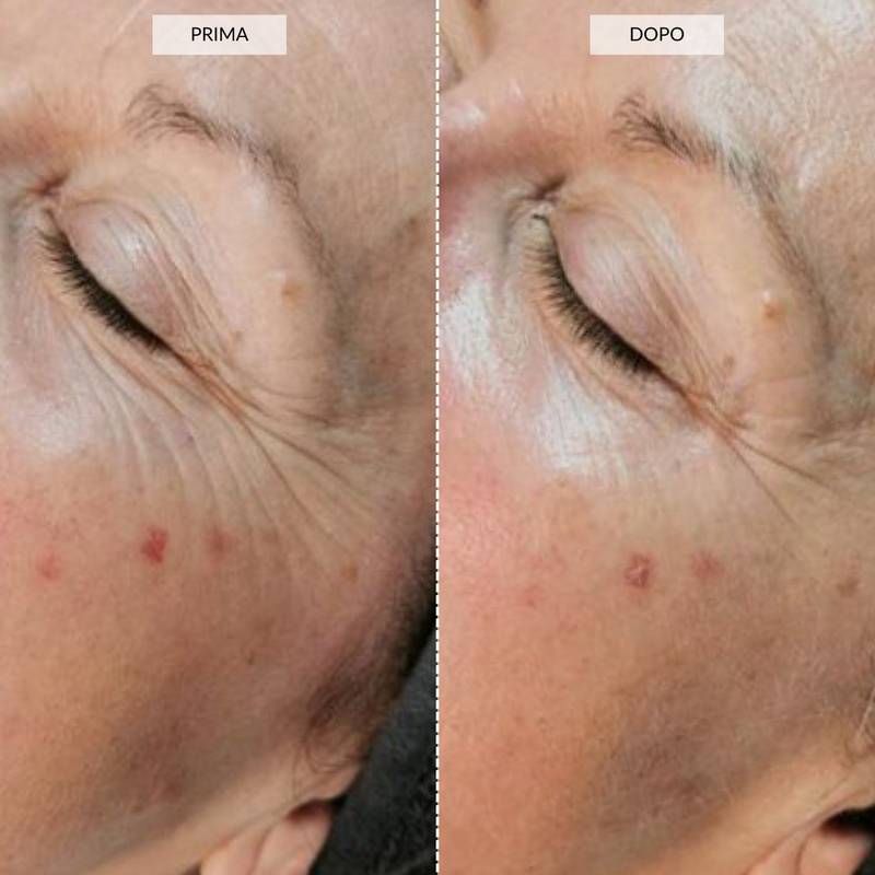 CurrentBody Skin Dispositivo di fototerapia a Luce LED Prezzo Ridotto