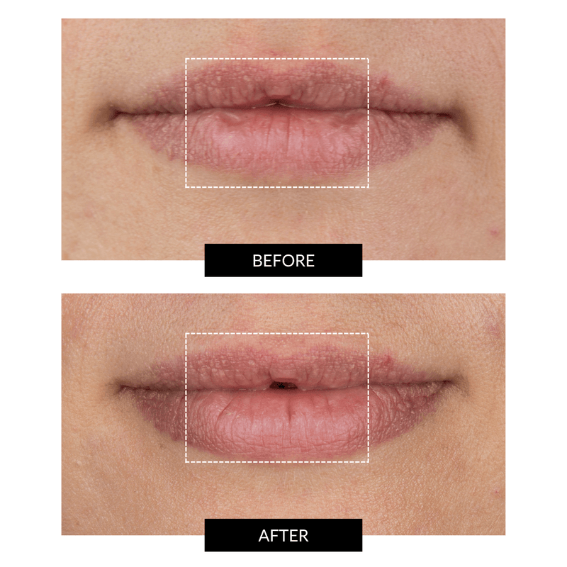 CurrentBody Skin LED Lip Perfector Presa