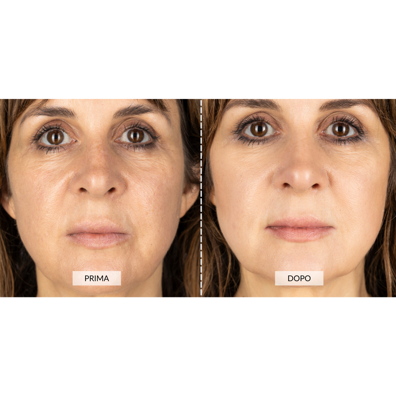 CurrentBody Skin Dispositivo a radiofrequenza per il viso RF Currentbody Skin Offerta