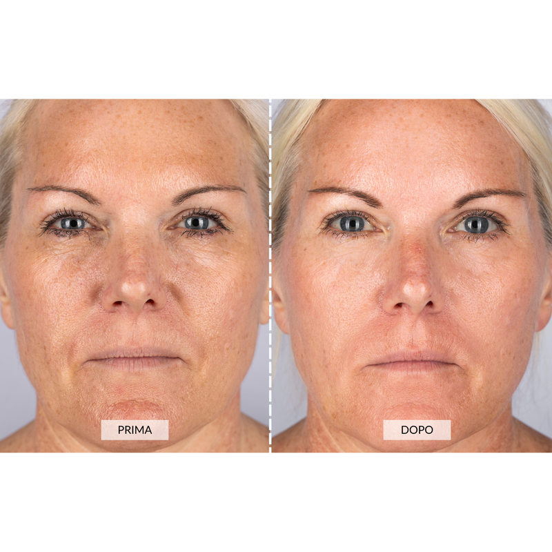 CurrentBody Skin Dispositivo a radiofrequenza per il viso RF Currentbody Skin Offerta