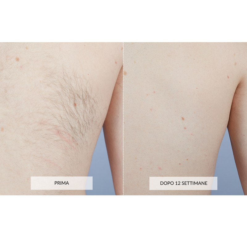 CurrentBody Skin Dispositivo di Epilazione Laser Negozio