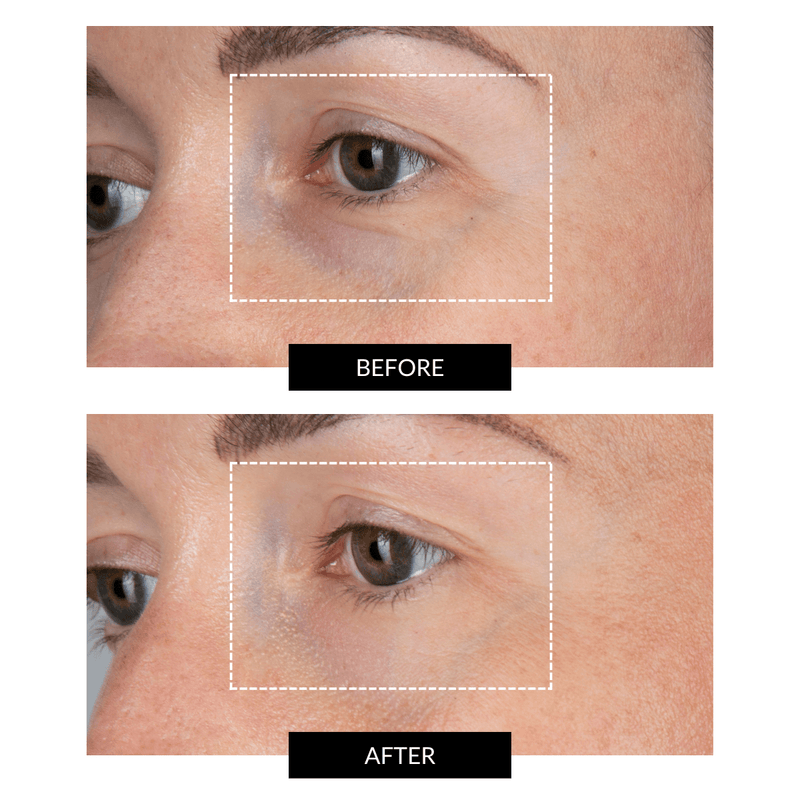 CurrentBody Skin LED Eye Perfector & 5 Eye Hydrogel Masks (del valore di 249€) Pezzi Unici