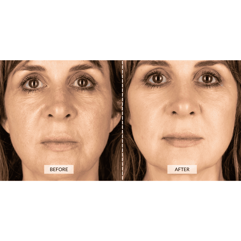 CurrentBody Skin Dispositivo a radiofrequenza RF x Sonia Sélaire Offerta